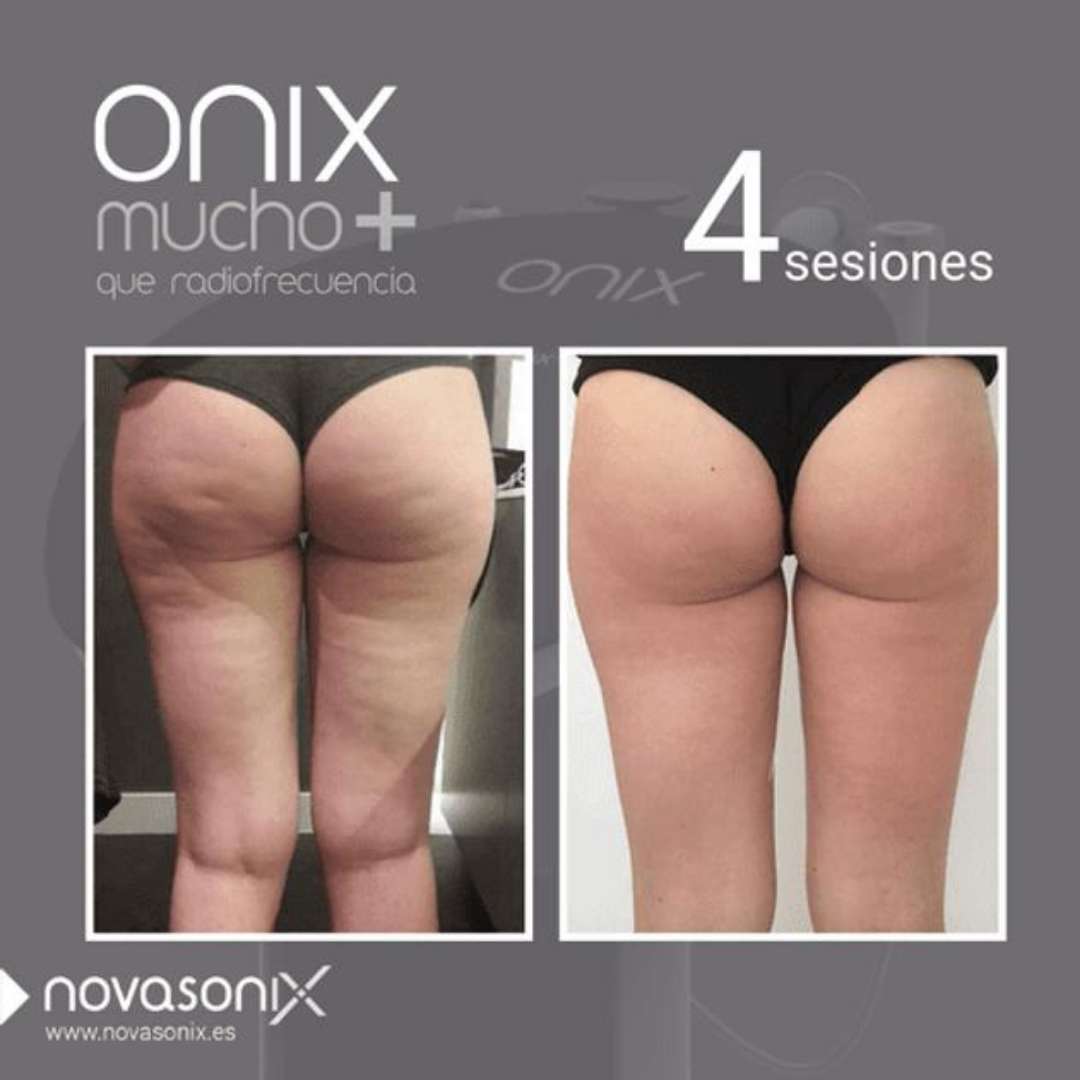 tractament onix galtes del cul