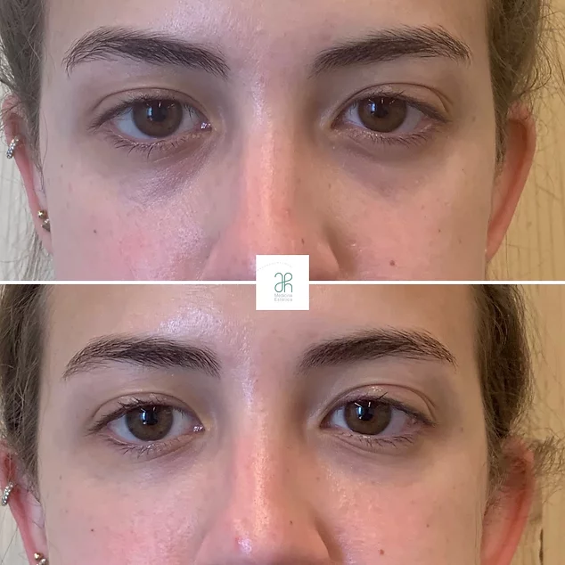 acid hyaluronic per a les ulleres