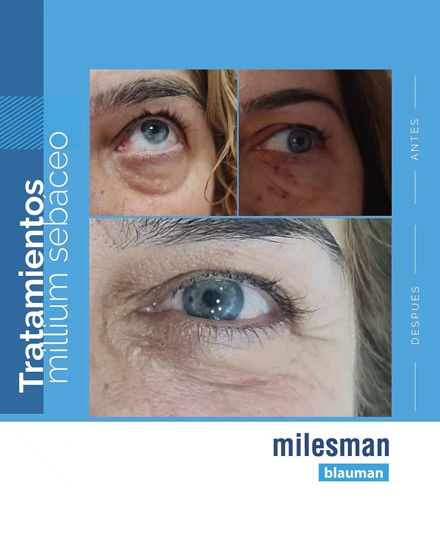 laser blau milium sebaceo