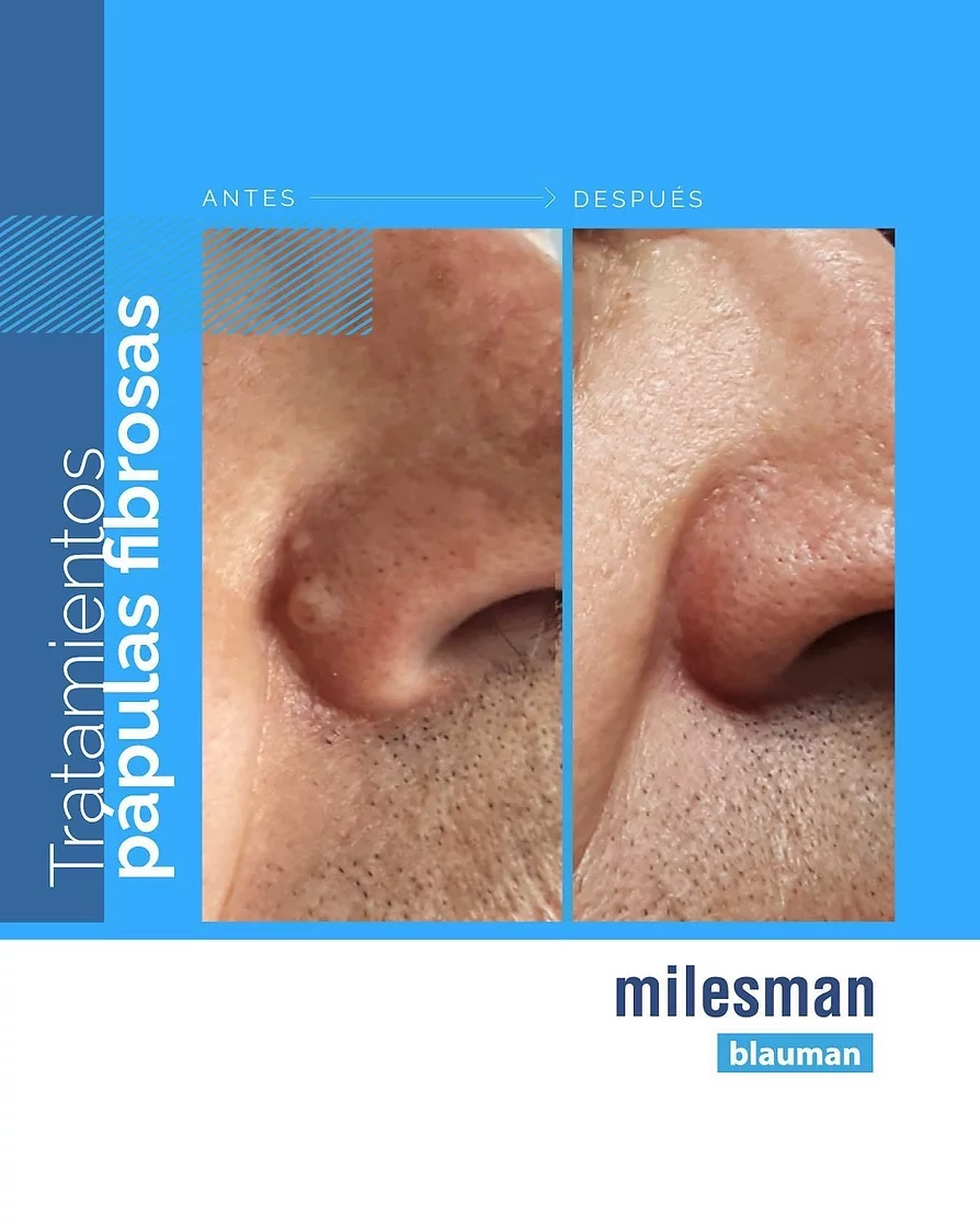 laser blau papulas fibrosas