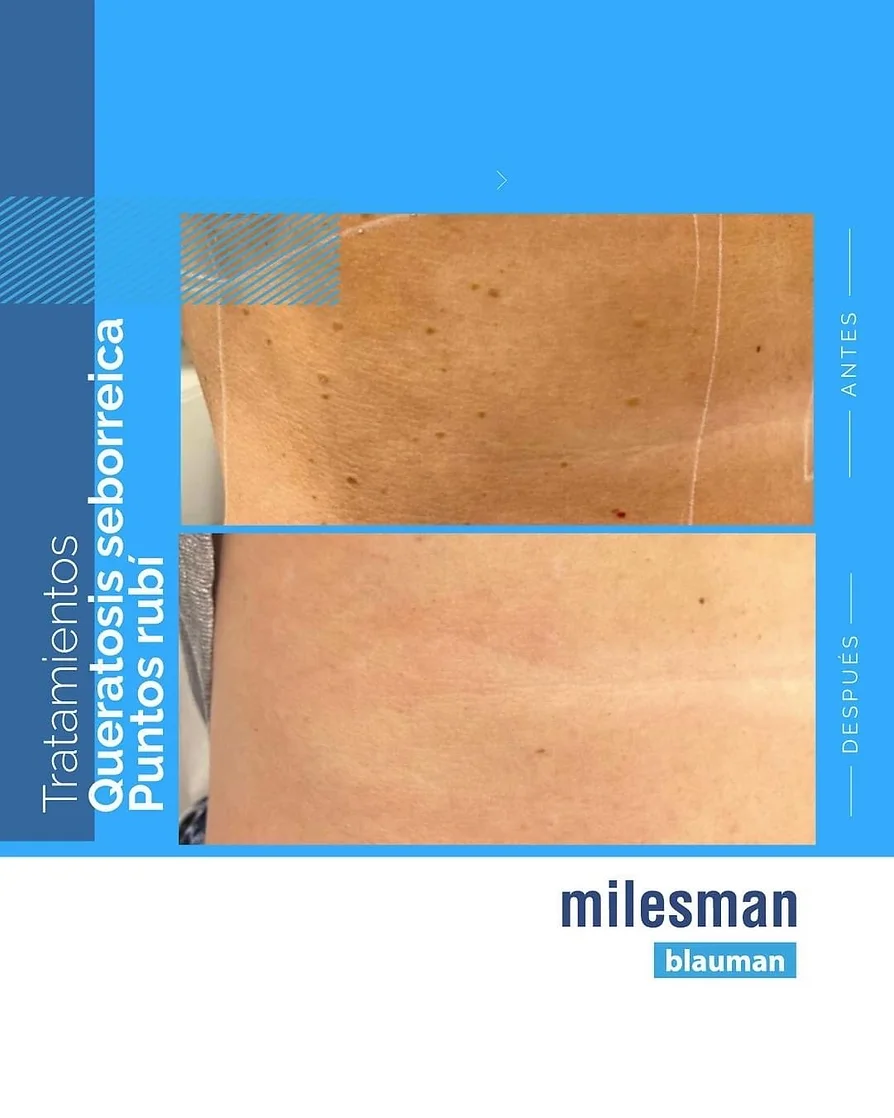 laser blau queratosis seborreica puntos rubi