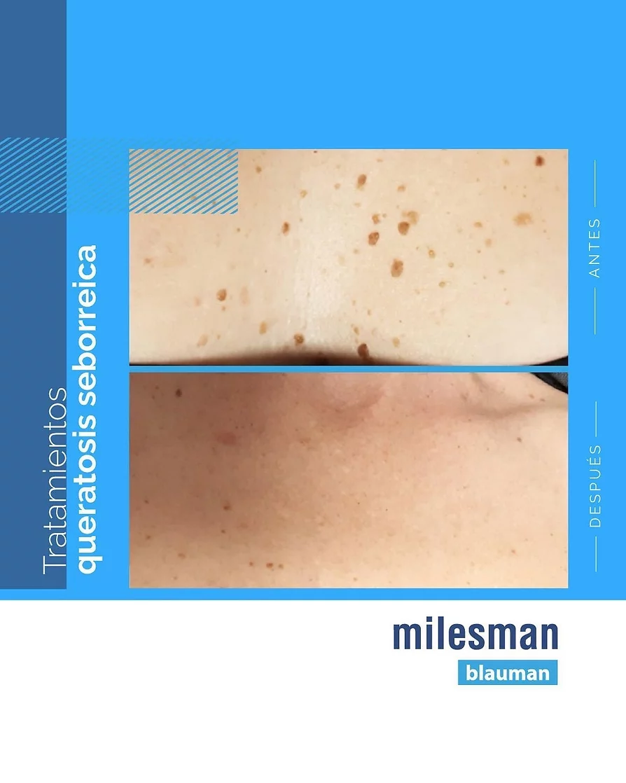 laser blau queratosis seborreica