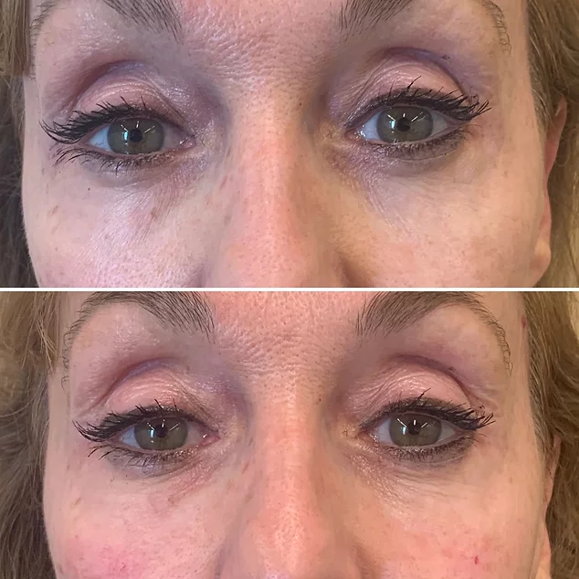 tractament d'acid hyaluronic per a les ulleres