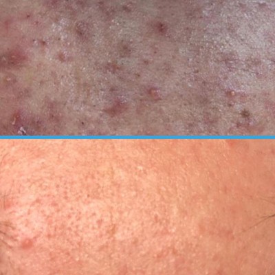 acne-1