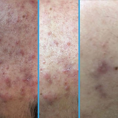 acne-2