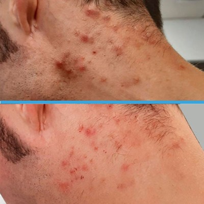 acne-3